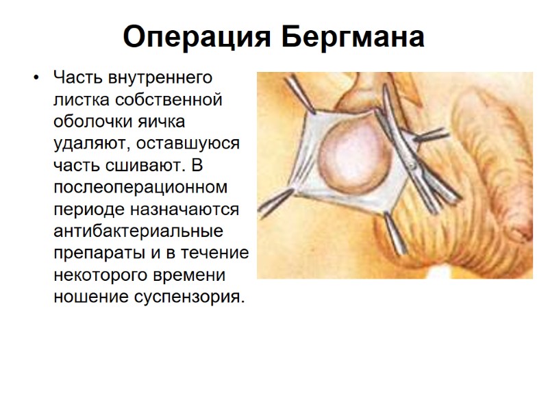 Операция Бергмана  Часть внутреннего листка собственной оболочки яичка удаляют, оставшуюся часть сшивают. В